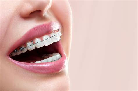 Diferencia entre brackets metálicos y de porcelana